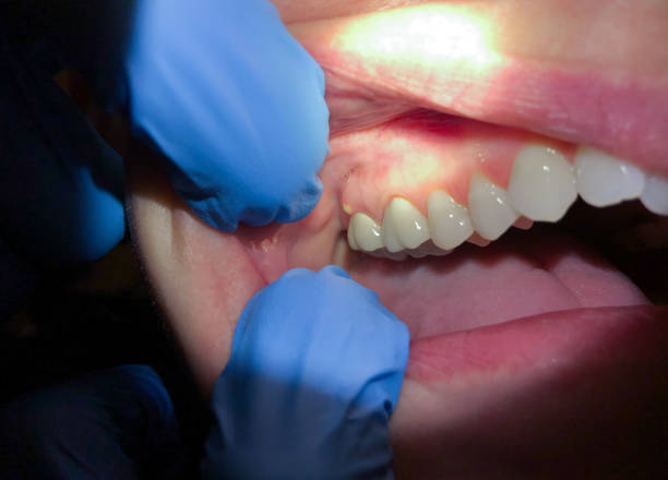 Best Broken or Chipped Tooth Repair in Menasha, WI
